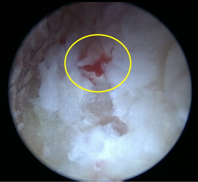 AUSS Assisted ACAF Technique in the Treatment of Ossification of the Posterior Longitudinal Ligament Extending to the C2 Segment.