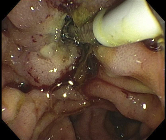 Biliary Radiofrequency Ablation and Sphincterotomy Restenosis: A Unique Case of Biliary Obstruction.
