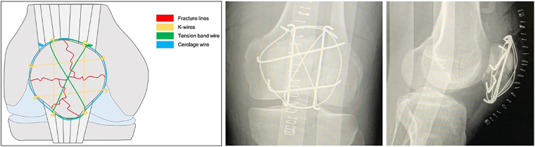 The 'hashtag' K-wires configuration for the management of severe comminuted patellar fracture: the combination of tension band technique and cerclage wiring.