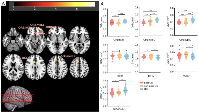 Abnormal structural changes and disturbed functional connectivity in patients with Crohn's disease and abdominal pain: a voxel-based morphometry and functional magnetic resonance imaging study.