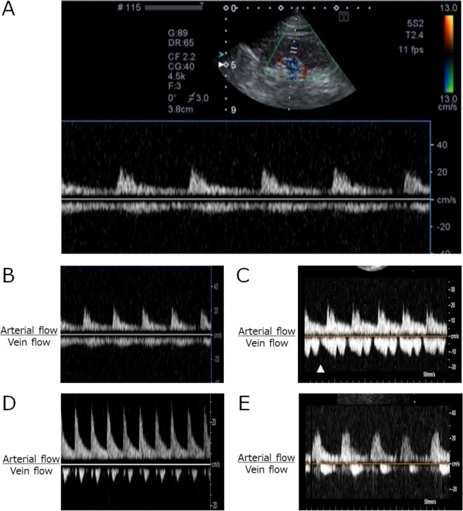Evaluation of intrarenal vein flow patterns during routine echocardiography.