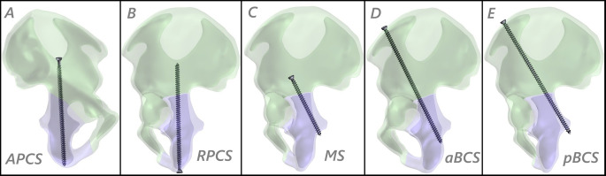 Is the innovative both column screw fixation technique a biomechanical game-changer in the fixation of acetabular posterior column fractures?