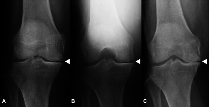 Three-Dimensional Lower Extremity Alignment During the Stance Phase of Gait Using Anteroposterior Fluoroscopic Imaging and Image-Matching Technique: A Comparison with the Standing Position in Advanced Knee Osteoarthritis.