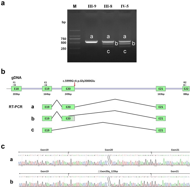 A novel splicing variant in TECTA associated with prelingual autosomal dominant nonsyndromic hearing loss via dominant-negative effect.
