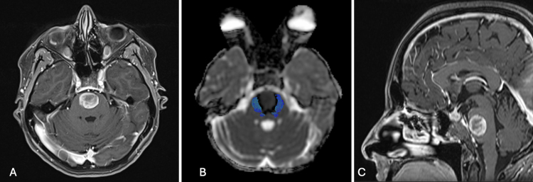 Endoscopic endonasal transclival approach for the resection of a ventral pontine cavernous malformation: illustrative case.