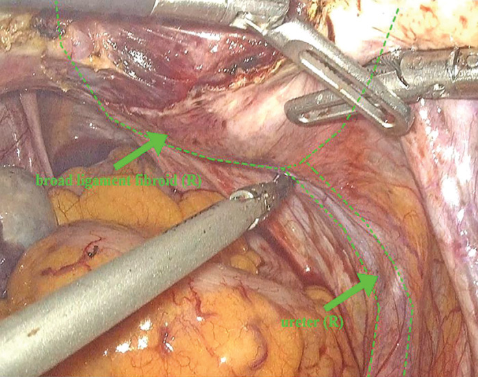Mobilization and protection of the ureter during laparoscopic total hysterectomy for cervical fibroids.