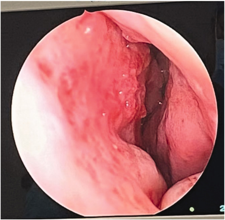Epistaxis due to hereditary hemorrhagic telangiectasia: A case report and literature review.
