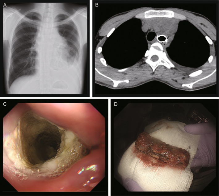 Hybrid Tracheal Stent Ingestion in Malignant Central Airway Stenosis: A Case Report.