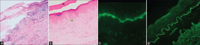 Lichen Planus Pemphigoides: A Clinical, Histopathological, and Immunological Report of 12 Indian Patients.