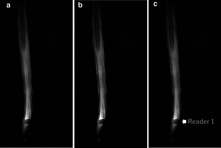 Super-resolution deep learning reconstruction to evaluate lumbar spinal stenosis status on magnetic resonance myelography.