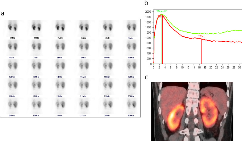 Imaging renal mitochondrial dysfunction in chronic kidney disease: a repurposed role for [<sup>99m</sup>Tc]Tc-MIBI SPECT/CT.