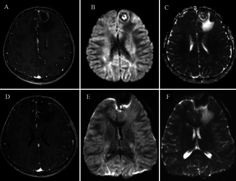 Anaplastic lymphoma kinase-positive primary CNS anaplastic large cell lymphoma in a pediatric patient: illustrative case.
