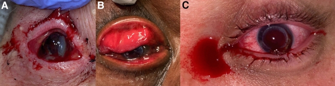 Corneal transplantation wound dehiscence after penetrating keratoplasty and deep anterior lamellar keratoplasty.
