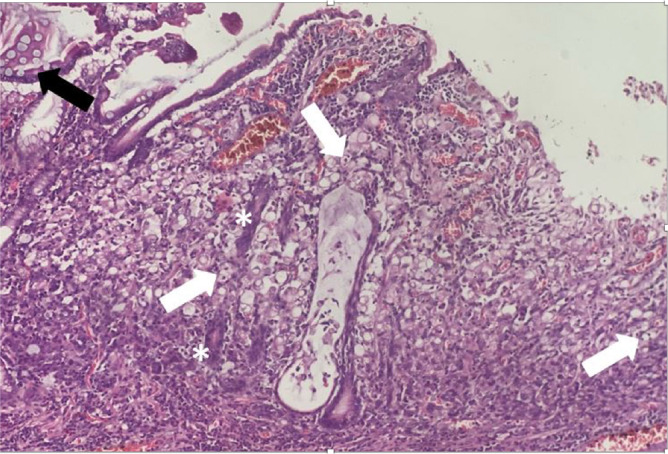 Preoperative CONUT score predicts postoperative complications in stage I-III gastric cancer patients undergoing curative gastric resections.