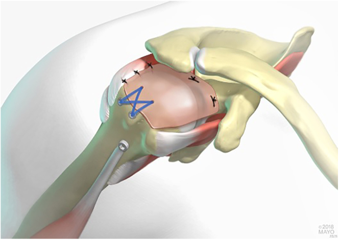 Exploring superior capsular reconstruction and tendon transfers for massive irreparable posterosuperior rotator cuff tears.