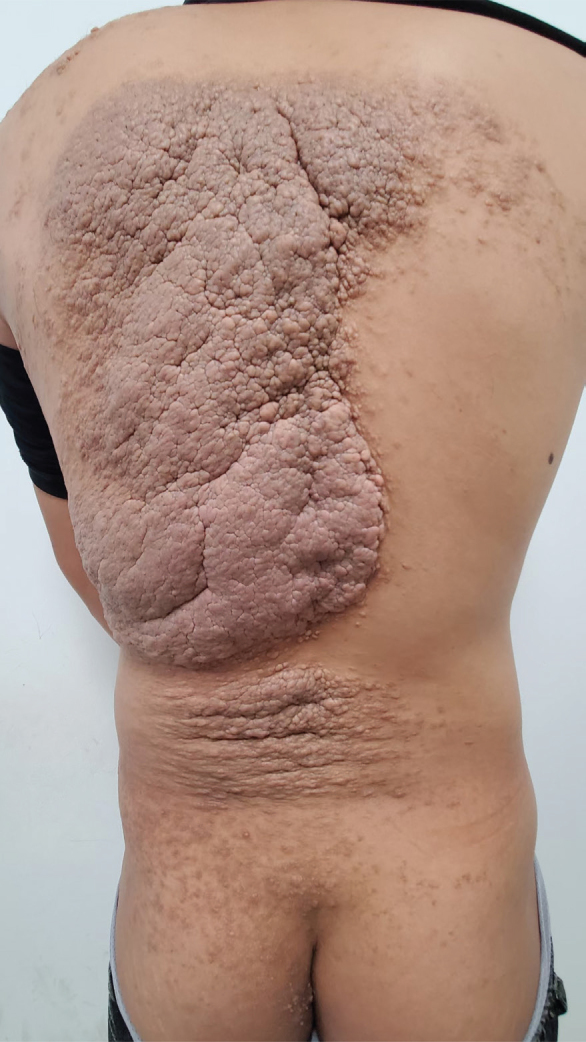 Giant Plaques on the Back with Gyrus-like Alteration: A Quiz.