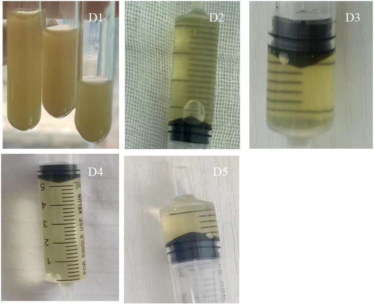 Cerebrospinal Fluid Exchange Combined with Intrathecal Antibiotic Injection for the Management of Severe Intracranial Infection Caused by Hypervirulent <i>Klebsiella pneumoniae</i>: A Case Report.
