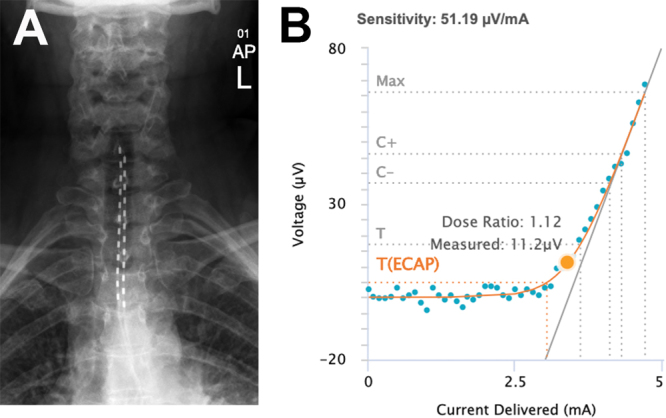 Significant pain reduction in refractory post-mastectomy pain syndrome with closed-loop spinal cord stimulation: illustrative cases.
