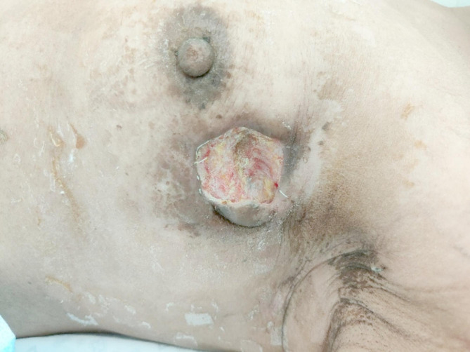 A case report of breast abscess caused by Peptoniphilus harei after endoscopic breast-conserving surgery and radiotherapy for breast cancer and literature review.