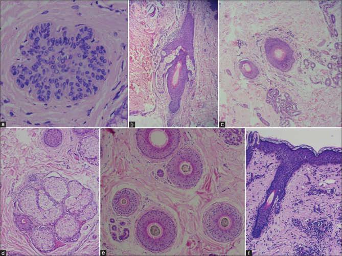 A Brief Review of Scalp Biopsy and its Interpretation.