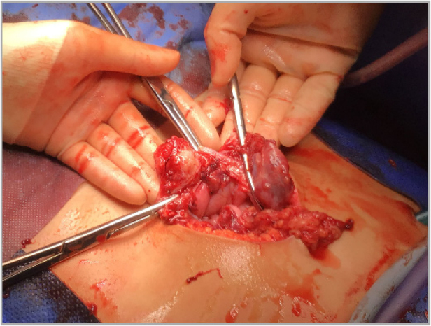 Intra-abdominal rhabdomyosarcoma in a paediatric patient presenting as acute appendicitis.