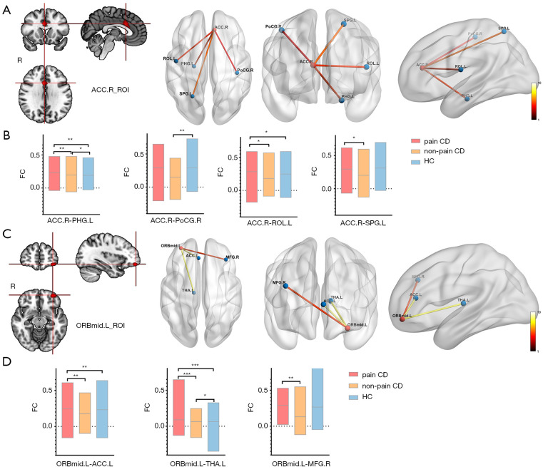Abnormal structural changes and disturbed functional connectivity in patients with Crohn's disease and abdominal pain: a voxel-based morphometry and functional magnetic resonance imaging study.