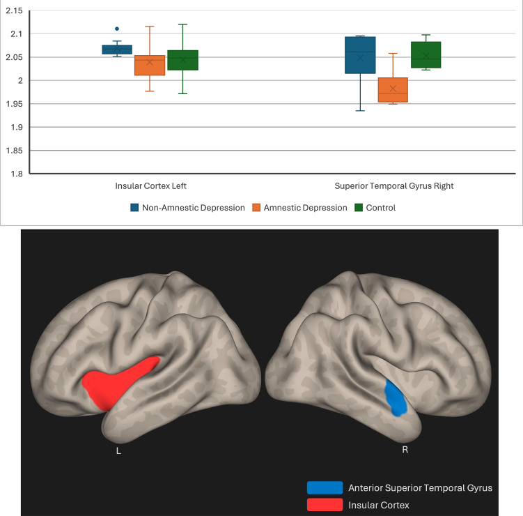 Subjective cognitive decline in major depressive patients is associated with altered entropy and connectivity changes of temporal and insular region.