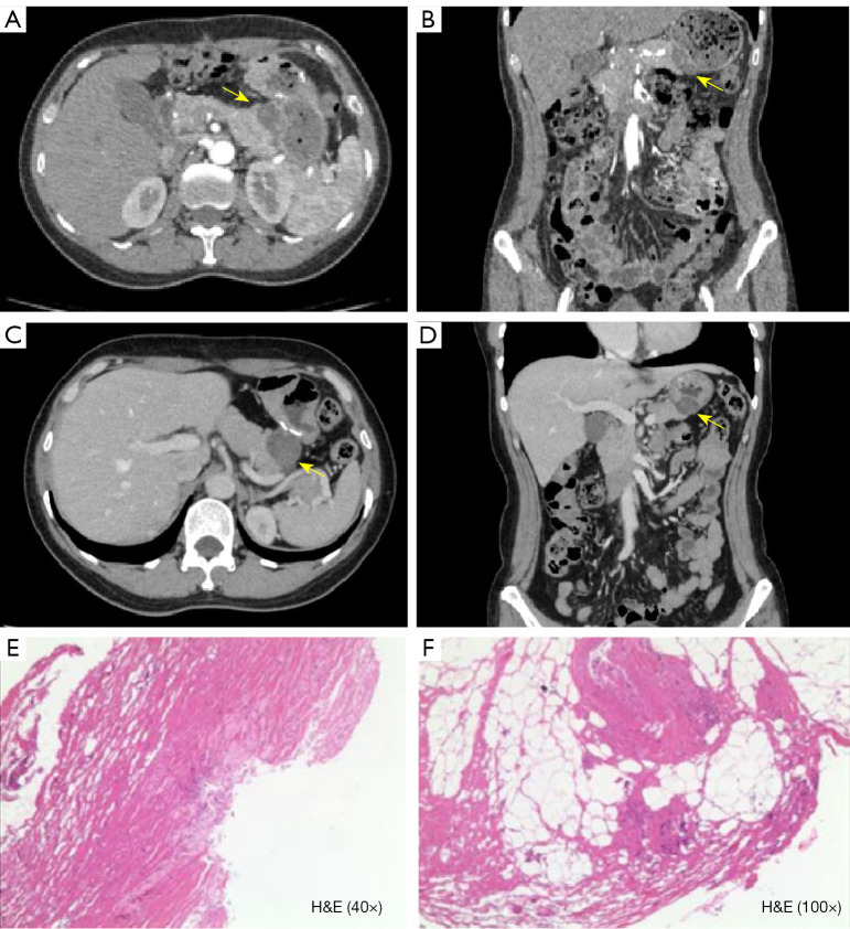 Enhancing postoperative recurrence assessment in gastric and colorectal cancer patients with intraperitoneal fluorouracil implants: overcoming the diagnostic challenge of fluorouracil implant-related tumor-like lesions.