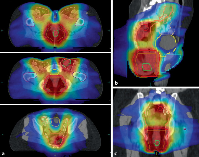 [Anal cancer-Interaction between outpatient and inpatient treatment].