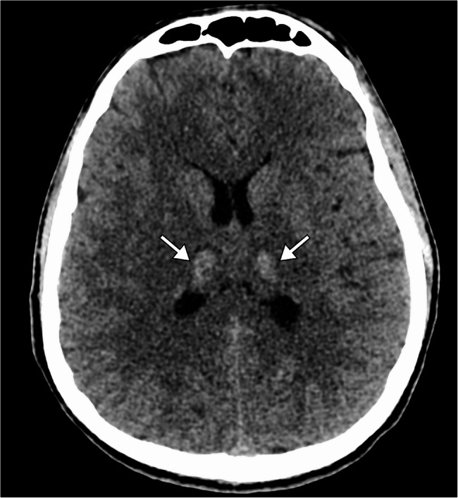 Acute necrotizing encephalopathy in a young adult triggered by adenovirus: a rare etiology of a devastating neurological syndrome.