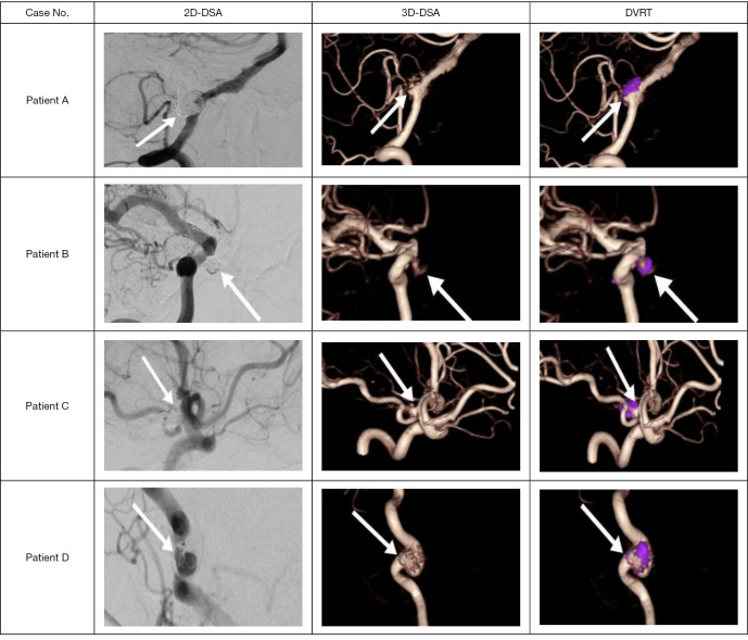 Dual-volume reconstruction technology in the detection and classification of recurrent aneurysms following intracranial aneurysm embolization.