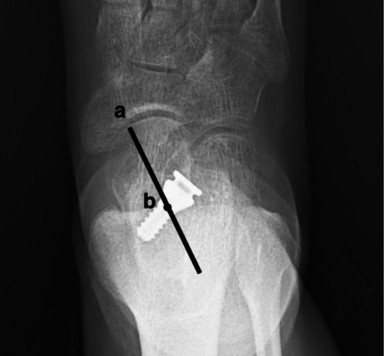 Risk Factors of Subtalar Arthroereisis for Progressive Collapsing Foot Deformity: A Retrospective Analysis of 236 Cases.