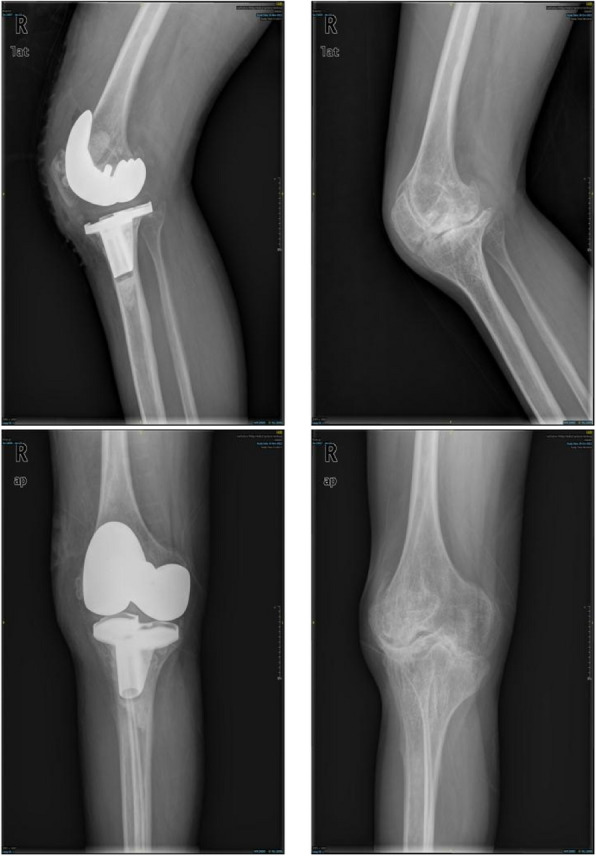 Total knee arthroplasty for ankylosed knees in the extended position with hemophilia: a medium- and long-term single-center experience.