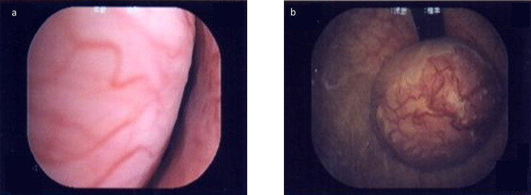 Bladder Leiomyoma Presenting with Recurrent Cystitis: A Case Report.