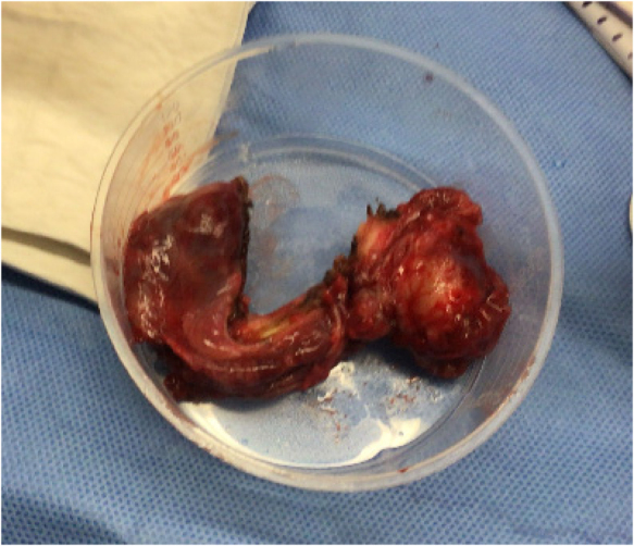 Intra-abdominal rhabdomyosarcoma in a paediatric patient presenting as acute appendicitis.