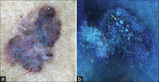 Dermoscopy and Ultraviolet Reflectance Dermoscopy of Benign Lichenoid Keratosis Masquerading as Melanoma.