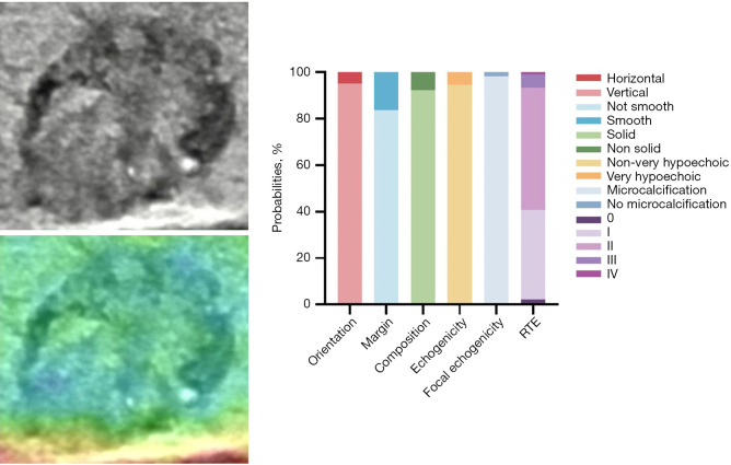 Enhancing diagnostic precision for thyroid C-TIRADS category 4 nodules: a hybrid deep learning and machine learning model integrating grayscale and elastographic ultrasound features.