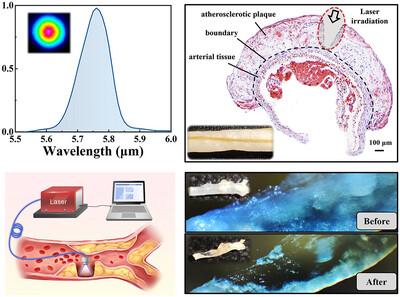 Efficient and Selective Ablation of Atheroma Using Watt-Level Mid-Infrared Femtosecond Laser at 5.75 µm