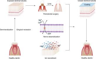 Advances in physical and chemical strategies for dentin hypersensitivity therapy