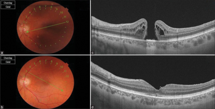 Comparison of superior and temporal inverted internal limiting membrane techniques in macular hole surgery: Surgical outcomes and the role of postoperative positioning.