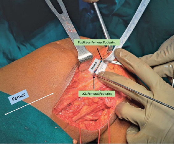 Finding the Optimal Balance - Isolated Posterolateral Corner Reconstruction with Allograft Tendon in a Combined Posterolateral Corner-Posterior Cruciate Ligament Injury: A Case Report.