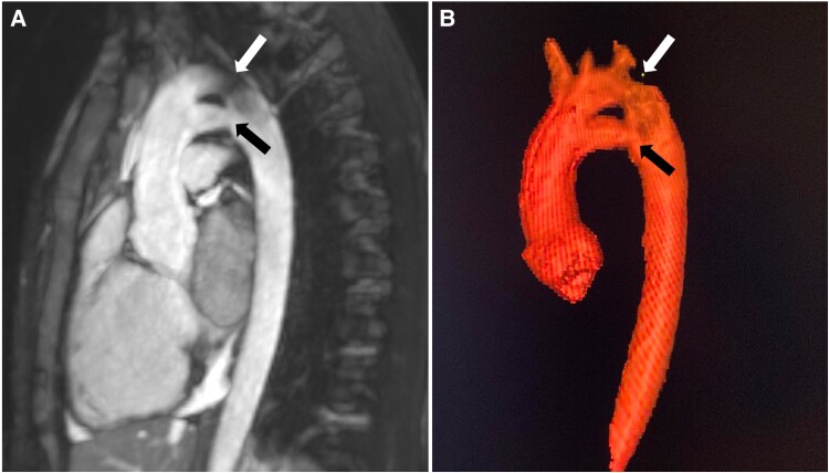 First case of isolated persistence of the fifth aortic arch observed on magnetic resonance imaging.