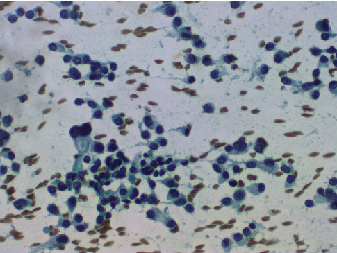 Multifocal Medullary and Papillary Thyroid Carcinoma Occurring as a Collision Tumor: A Case Report.