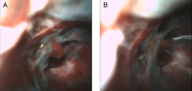Direct Intranodal Visualization During EBUS-TBNA Using the Iriscope: A Novel Case Series.