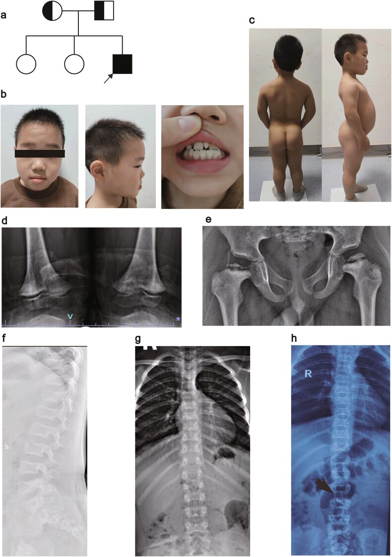 A case report of SPONASTRIME dysplasia with novel TONSL mutation: genetic analysis, clinical manifestations, and the effect of growth hormone treatment.