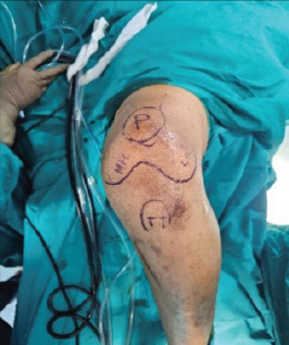 Simultaneous ACL Reconstruction and MCL Reconstruction in Patients with High BMI using Modified Lind Technique.