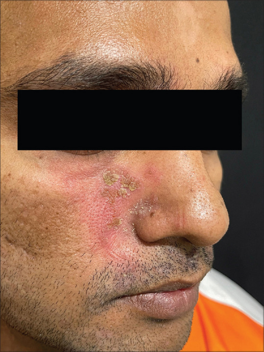 Seborrhoea Herpeticum: A distinct entity or mere coincidence.