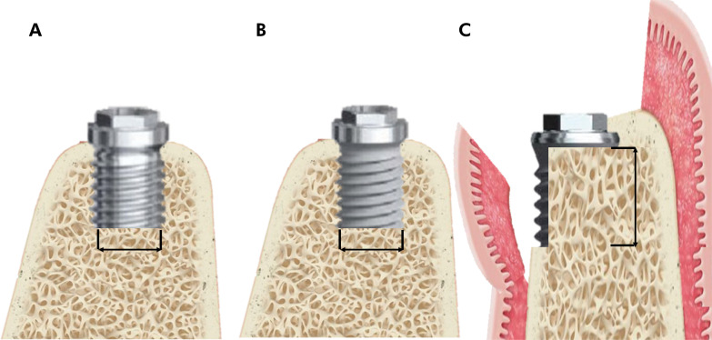 Influence of residual buccal bone thickness in dehiscence defects on osseointegrated dental implants in healed sites: an experimental in vivo study.