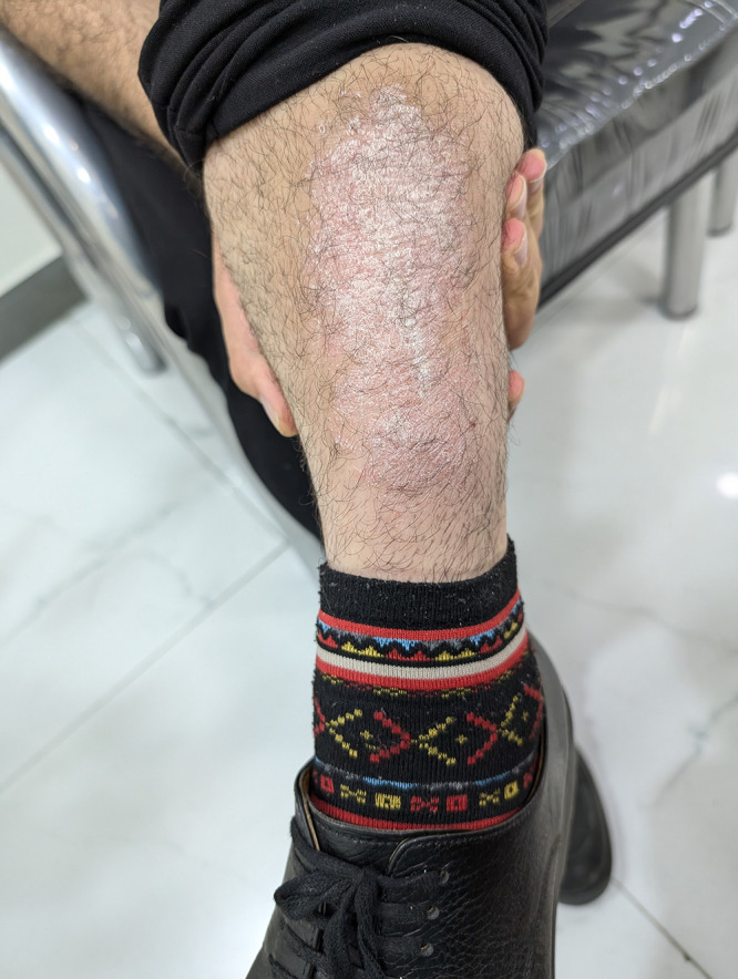 Eosinophilia Induced by Biosimilar Adalimumab (CinnoRA) in a Patient with Psoriasis and Psoriatic Arthritis: A Case Report.