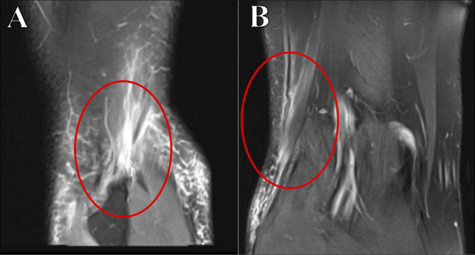 Distal Hamstring Injuries and Disorders.